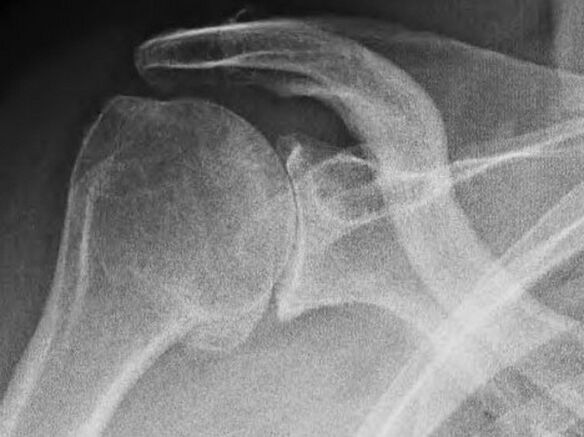 Artroosist kahjustatud õlaliigese röntgen