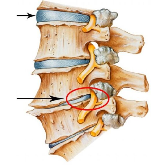 emakakaela osteokondroos
