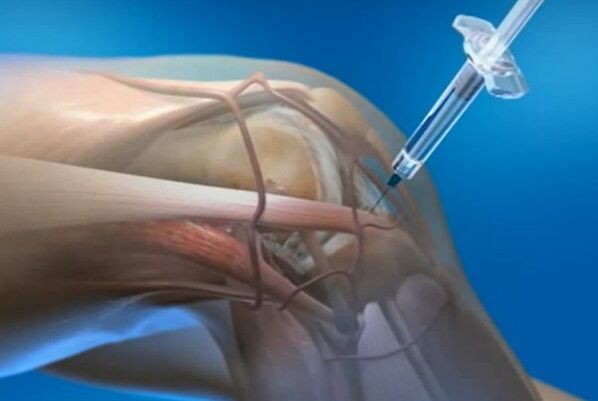 intraartikulaarsed süstid põlveliigese artroosi korral